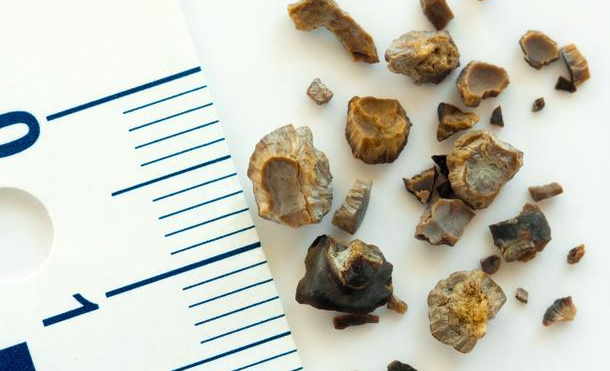 有什么食物可以預防結石的形成？深圳送菜公司?為您解讀